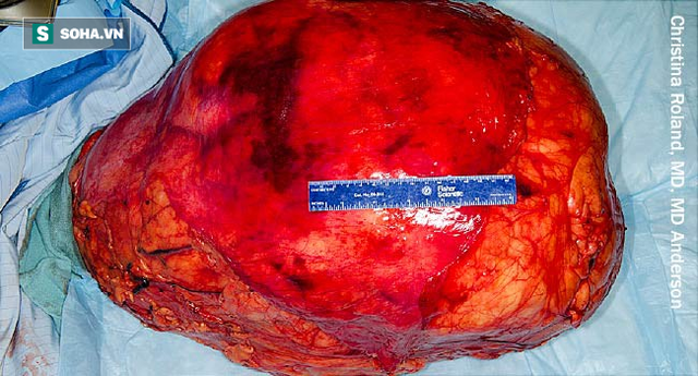 Ung thư tế bào mỡ: Những người có lớp mỡ bụng dày thật sự rất đáng lo ngại! ảnh 1