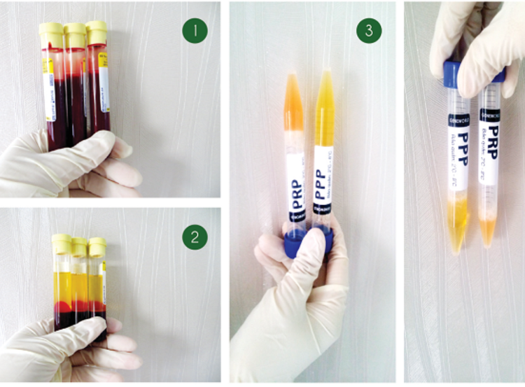 tách huyết tương