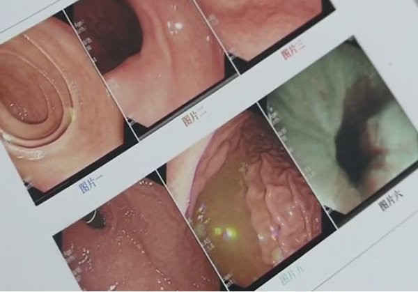 Cảnh báo chảy máu dạ dày bởi món ăn vặt phổ biến mùa lạnh ảnh 3