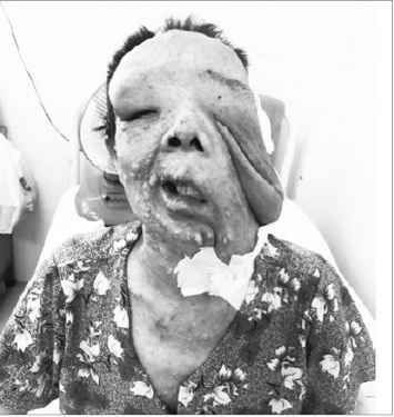 Bệnh nhân H. trước khi được điều trị. (ảnh: BVCC)