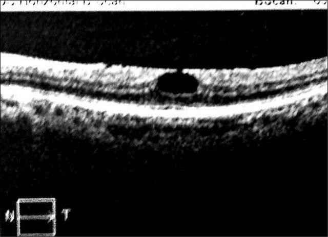 Lỗ thủng trên lớp tế bào võng mạc