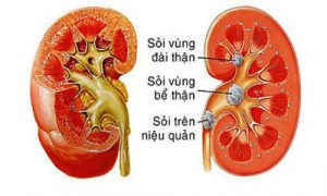 sỏi thận
