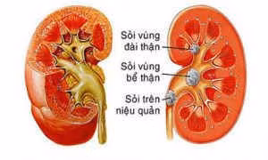 sỏi thận