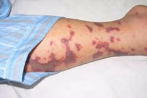 Vì sao viêm não mô cầu lại hay tấn công trẻ bụ bẫm, người khỏe mạnh? ảnh 1