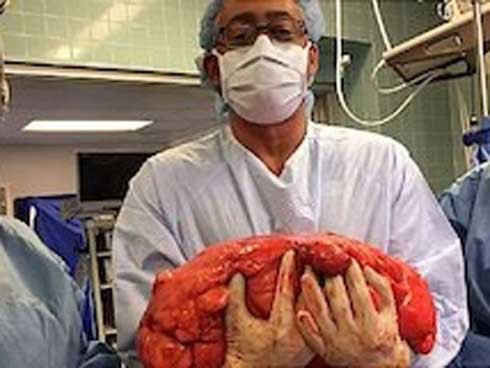 Ung thư tế bào mỡ: Những người có lớp mỡ bụng dày thật sự rất đáng lo ngại! ảnh 2