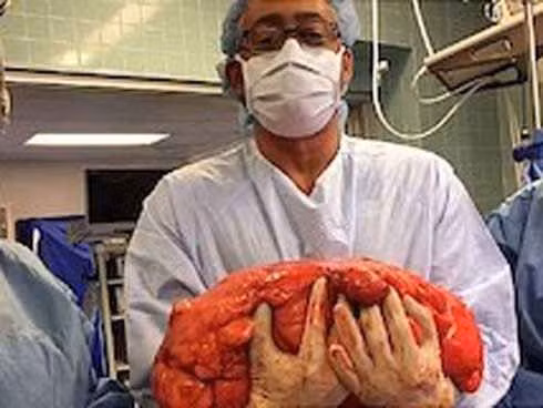 Ung thư tế bào mỡ: Những người có lớp mỡ bụng dày thật sự rất đáng lo ngại! ảnh 2