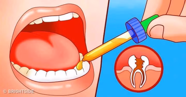 11 cách giúp bạn dịu cơn đau do mọc răng khôn hình 7 11 cach giup ban diu con dau do moc rang khon hinh 7