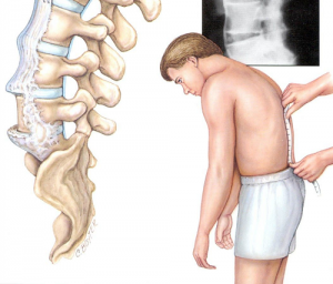 viêm cột sống dinh khớp