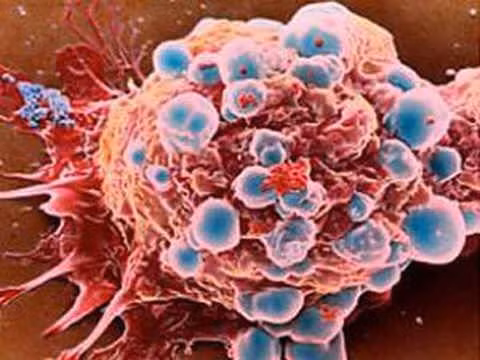 6 bệnh ung thư hay gặp ở phụ nữ - ảnh 2