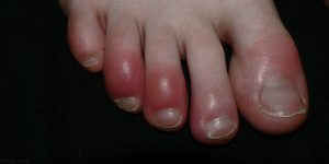 4 cách phòng tránh cước tay chân mùa lạnh ảnh 1