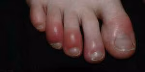 4 cách phòng tránh cước tay chân mùa lạnh ảnh 1