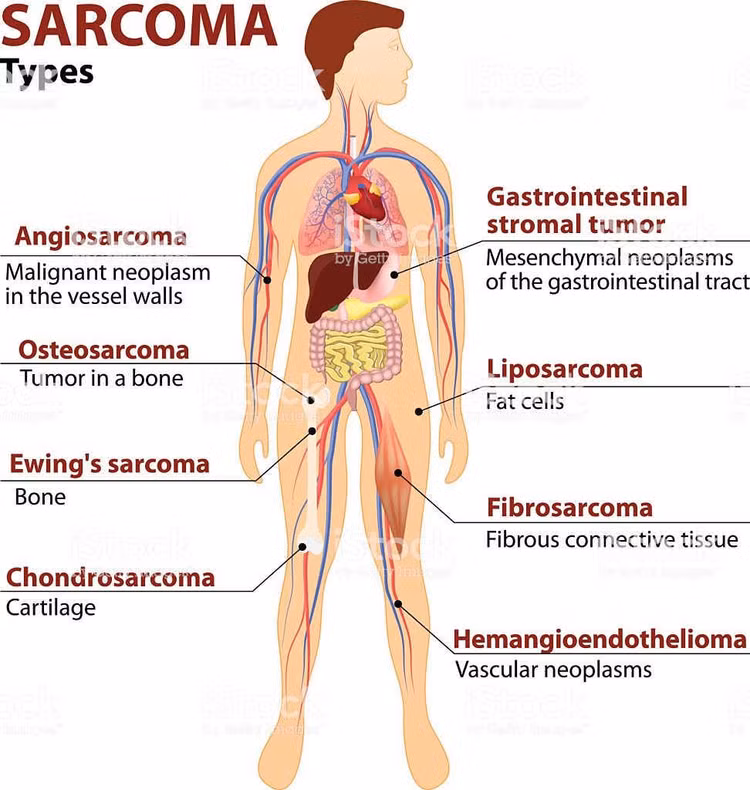 Ung thư Sarcoma