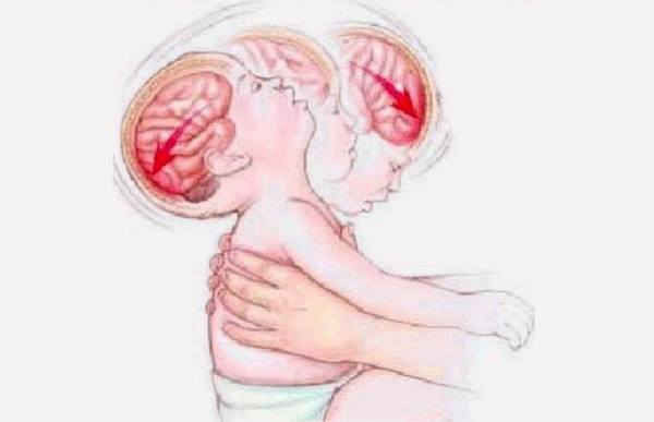 Não trẻ bị ảnh hưởng nghiêm trọng thế nào khi bị rung lắc, quăng quật? ảnh 2