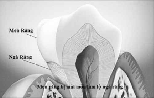 Men răng bị mài mòn làm lộ ngà răng gây đau và ê buốt chân răng.