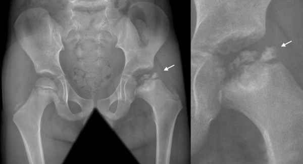 Bệnh lý đau khớp háng ở trẻ