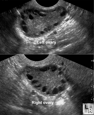 Hình ảnh siêu âm của bệnh nhân mắc hội chứng đa nang buồng trứng.