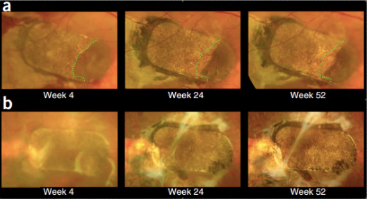 Ảnh chụp đáy mắt cho thấy các tế bào mới sẫm màu hơn đã mọt lên quanh miếng dán sau một năm.