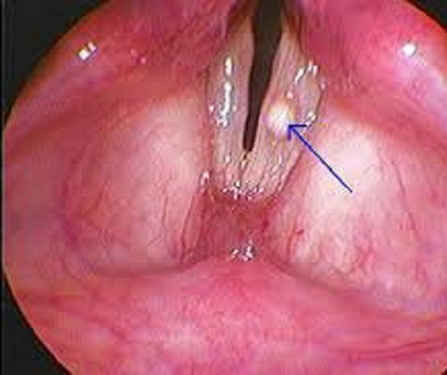 Hạt xơ dây thanh, polyp là nguyên nhân gây khàn tiếng.