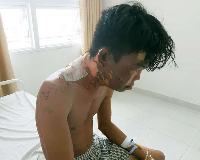 Thanh niên 24 tuổi bị chị gái đổ nồi nước sôi lên đầu - ảnh 1