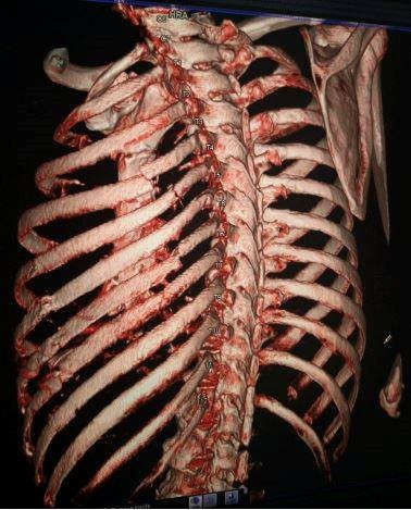 Hình ảnh xương bị gẫy sau tai nạn trên đường phơi rơm