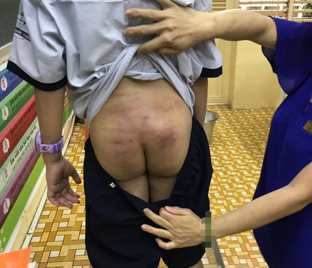 TPHCM: Nghi vấn bé trai bị bạo hành kéo dài khi ở cùng bố, mẹ kế - 1