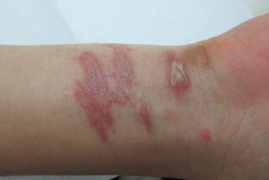 Viêm da thường xuất hiện ở vùng mặt, cổ, ngực, gáy, tay...