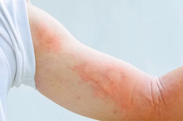 Tại bệnh viện, các bác sĩ chẩn đoán Tiểu Lý bị mề đay, may mắn thay, Tiểu Lý được các bác sĩ cho dùng thuốc kháng histamine và điều chỉnh chế độ ăn uống, tình trạng da của cô đã được cải thiện rất nhiều.