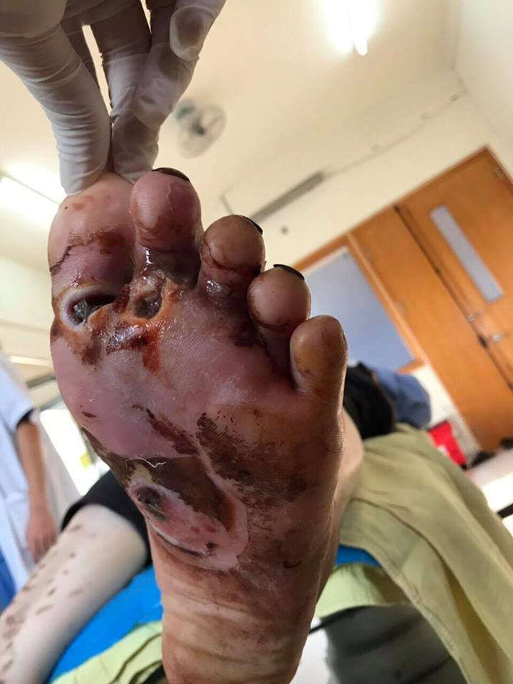 Bàn chân bị biến chứng hoại tử do đắp lá của bệnh nhân