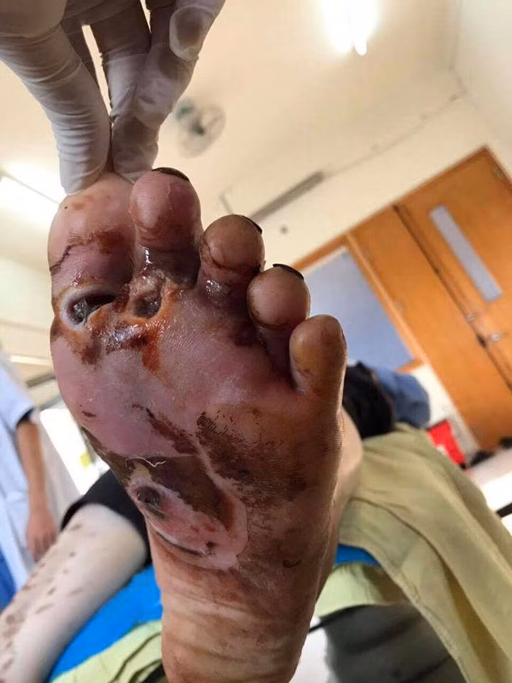 Bàn chân bị biến chứng hoại tử do đắp lá của bệnh nhân