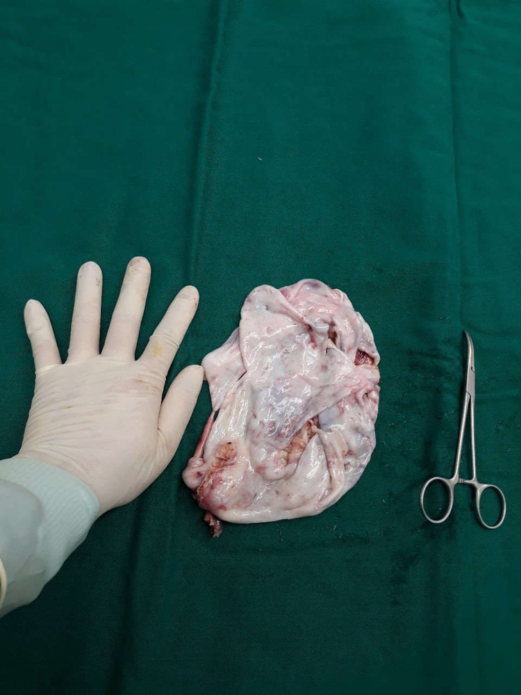 Khối u của bệnh nhân T. sau khi đã được chọc hút