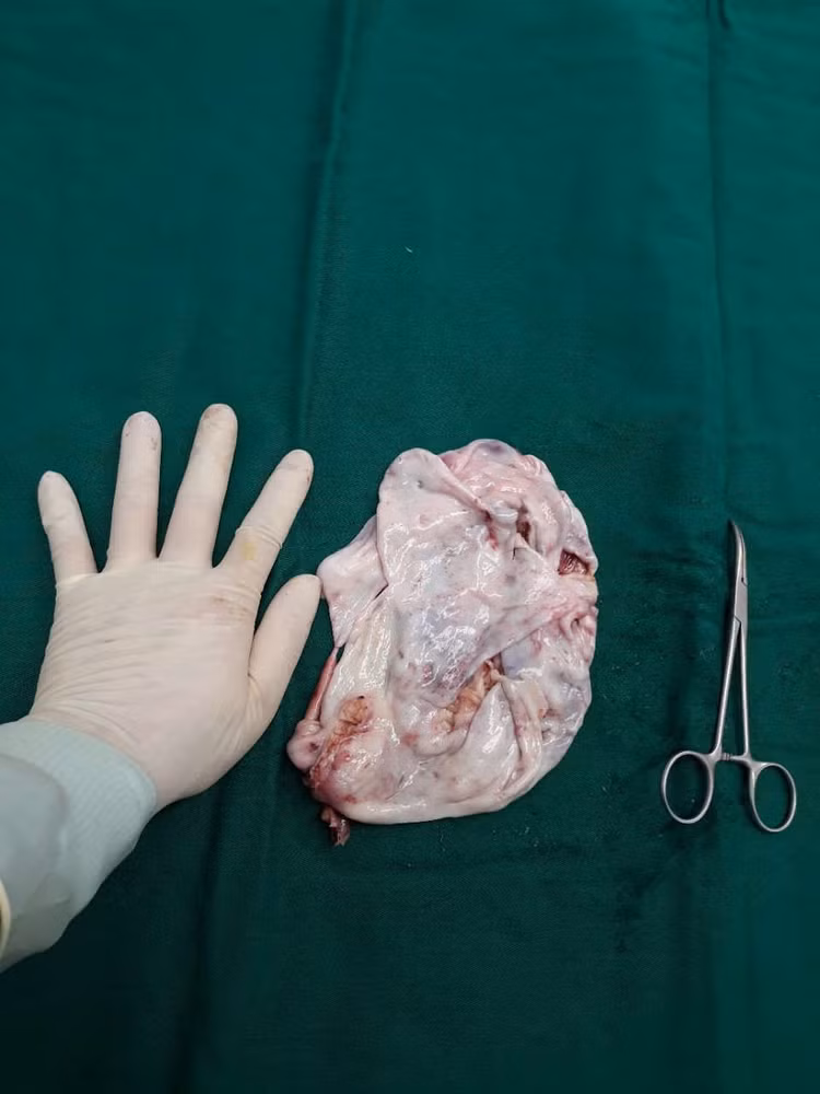 Khối u của bệnh nhân T. sau khi đã được chọc hút