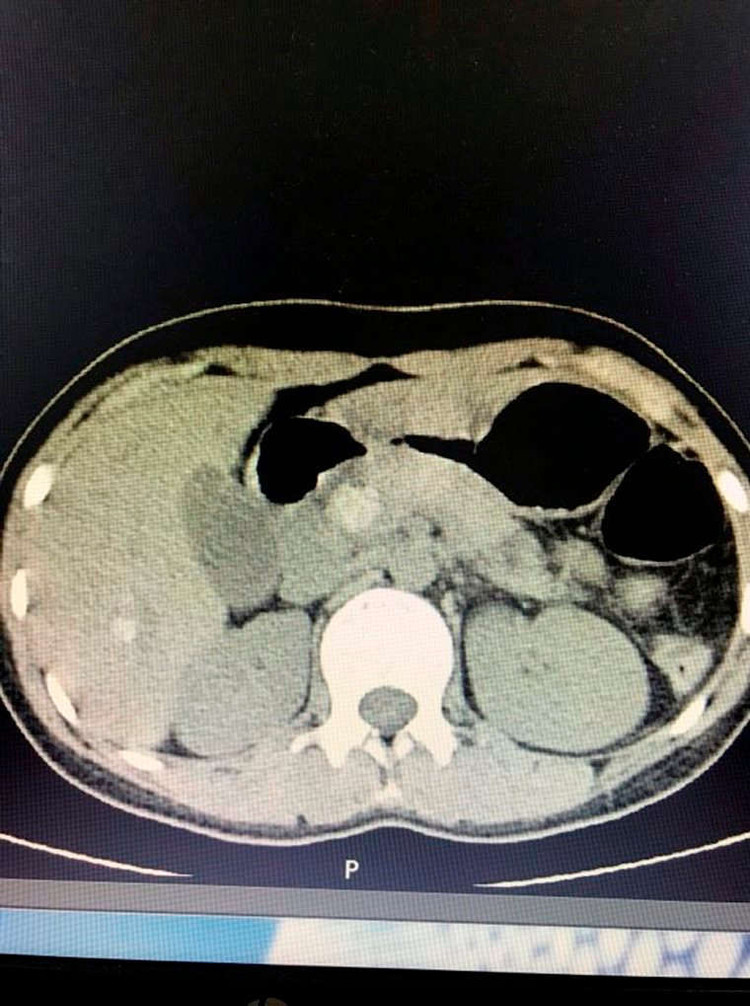 Viên sỏi to kẹt chặt tại vị trí Oddi