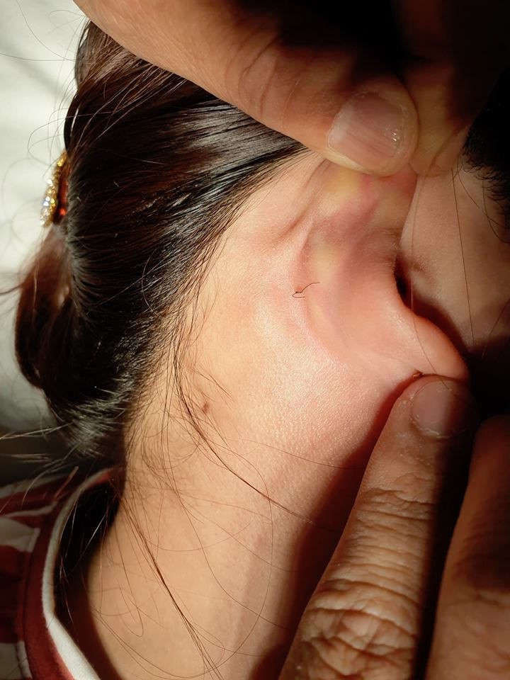 Hoại tử mũi, nát ngực vì làm đẹp đón Tết - ảnh 2