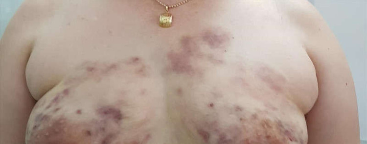 Hoại tử mũi, nát ngực vì làm đẹp đón Tết - ảnh 3