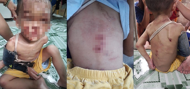 Hình ảnh bé trai bị gãy tay và những vết sẹo trên người. Ảnh: NT/ Plo.vn