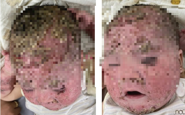 Bệnh nhân lúc mới nhập viện điều trị tại Bệnh viện Da liễu Trung ương. - Ảnh: Sức khỏe và Đời sống