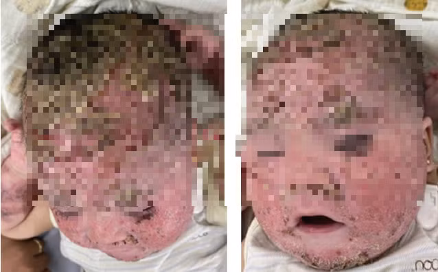 Bệnh nhân lúc mới nhập viện điều trị tại Bệnh viện Da liễu Trung ương. - Ảnh: Sức khỏe và Đời sống