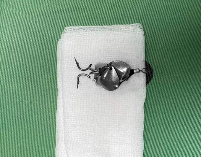 Chiếc lưỡi câu cá móc vào mắt bé trai, được các bác sĩ phẫu thuật gỡ ra. Ảnh: BVCC/ VnExpress