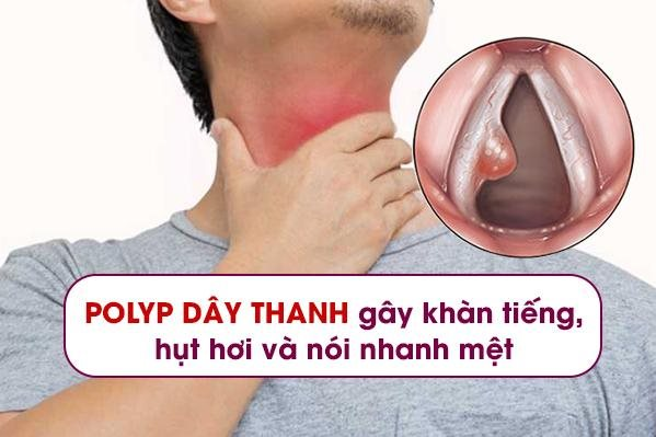 anh-minh-hoa-polyp.png