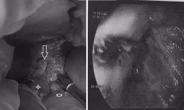 Hình ảnh thực quản trong nội soi dạ dày (bên phải) và lỗ thủng thực quản phát hiện khi phẫu thuật vùng bụng.