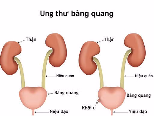 u-bang-quang-tinh-hoa.jpg
