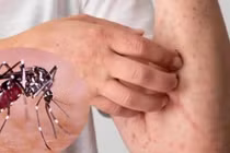 Cảnh báo sốt xuất huyết gia tăng do thời tiết thất thường
