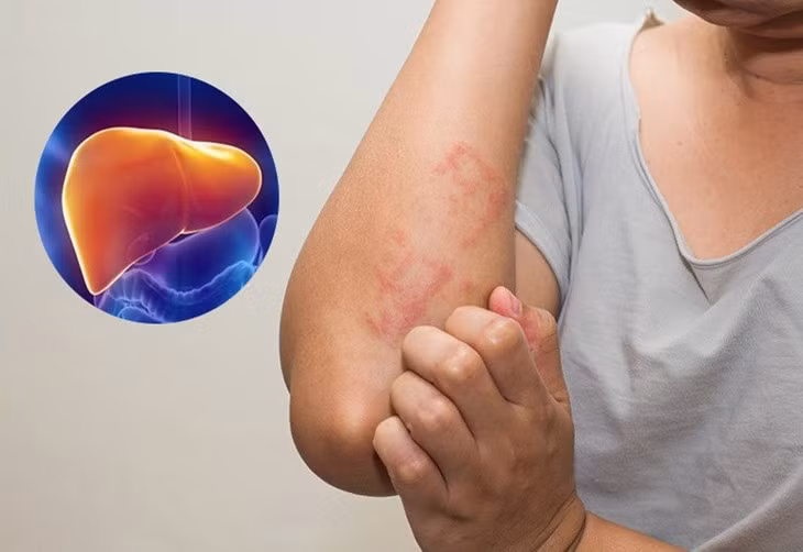 Dấu hiệu trên da cảnh báo gan nhiễm mỡ, cần đi khám ngay. Ảnh minh họa Dấu hiệu trên da cảnh báo gan nhiễm mỡ, cần đi khám ngay. Ảnh minh họa