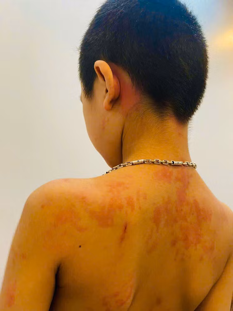 Hình ảnh ban đỏ, mẩn ngứa trên người bệnh nhi. Ảnh BVCC Hình ảnh ban đỏ, mẩn ngứa trên người bệnh nhi. Ảnh BVCC