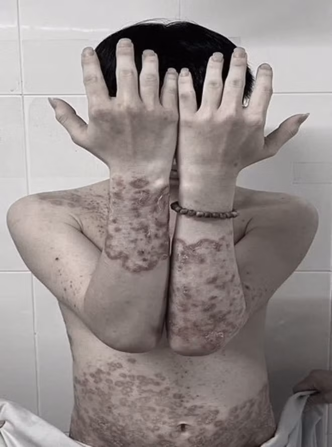 Dát, mảng đỏ hình tròn, đa cung ở tay, thân mình. Ảnh: SK&amp;ĐS