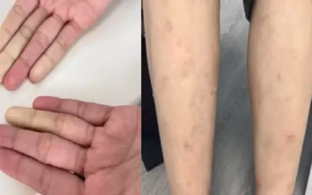 Ngỡ ngàng nhận chẩn đoán mắc đồng thời hai bệnh tự miễn. Ảnh BVCC Ngỡ ngàng nhận chẩn đoán mắc đồng thời hai bệnh tự miễn. Ảnh BVCC