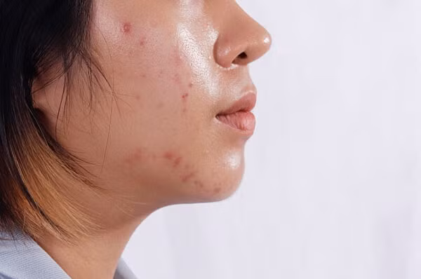 Tình trạng da nhờn, mụn, lỗ chân lông to. Ảnh minh họa Tình trạng da nhờn, mụn, lỗ chân lông to. Ảnh minh họa
