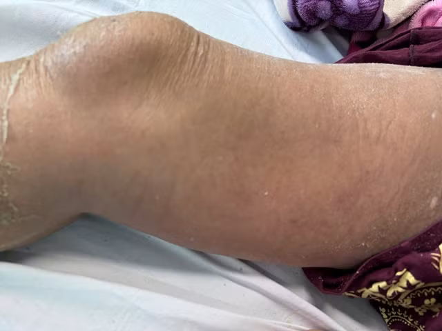 Sau thời gian điều trị, tình trạng viêm mô tế bào của bệnh nhân đã ổn định. Ảnh BVCC Sau thời gian điều trị, tình trạng viêm mô tế bào của bệnh nhân đã ổn định. Ảnh BVCC