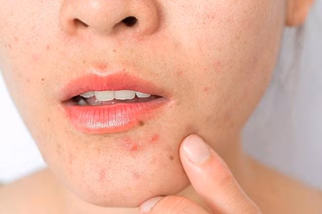 Sai lầm trong chăm sóc da khiến càng chăm càng nhiều mụn - Ảnh minh họa