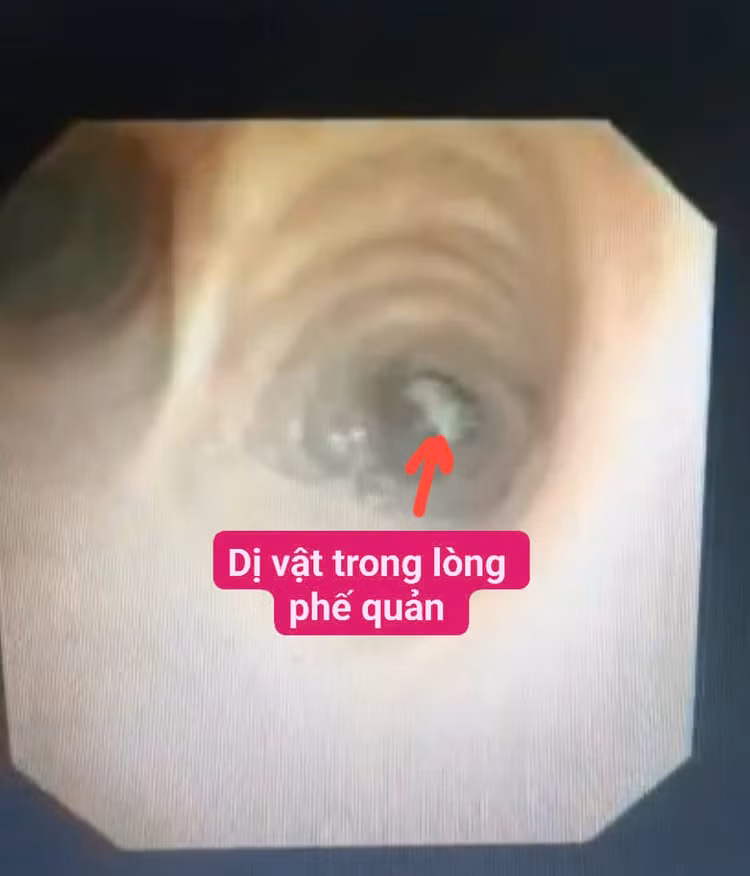 Dị vật trong phế quản bệnh nhân. Ảnh BVCC
